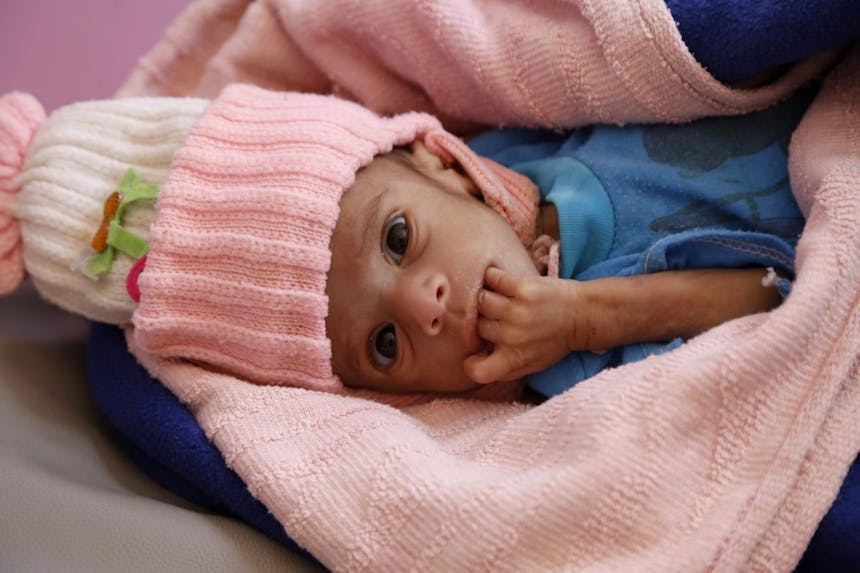 Hassan, 6 maanden oud uit Jemen ligt in bed gewikkeld in dekens en krijgt medicatie tegen ondervoeding