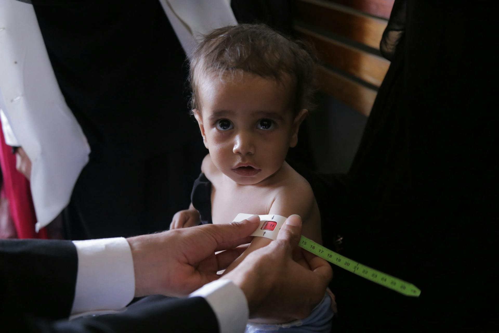 Mohammed Fahad Asaadi (1 jaar oud) is ondervoed en krijgt daarom een medisch onderzoek.