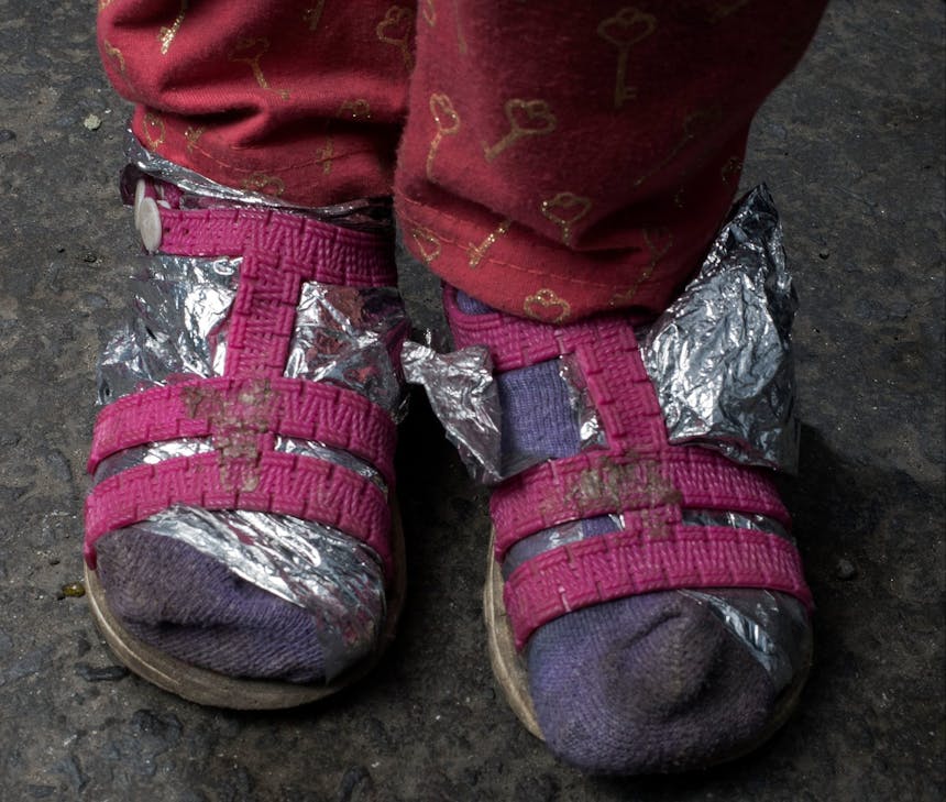 Nicole , 4 jaar oud uit Venuzuela met voeten in alimunium gewikkeld zodat ze warm blijven.